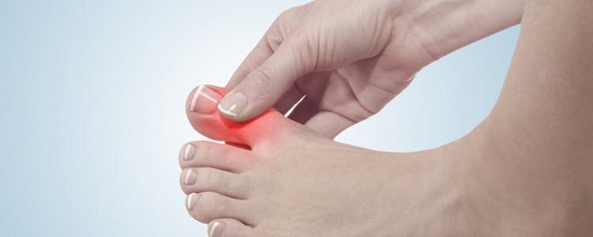 Physiotherapie Bei Einem Hallux Rigidus